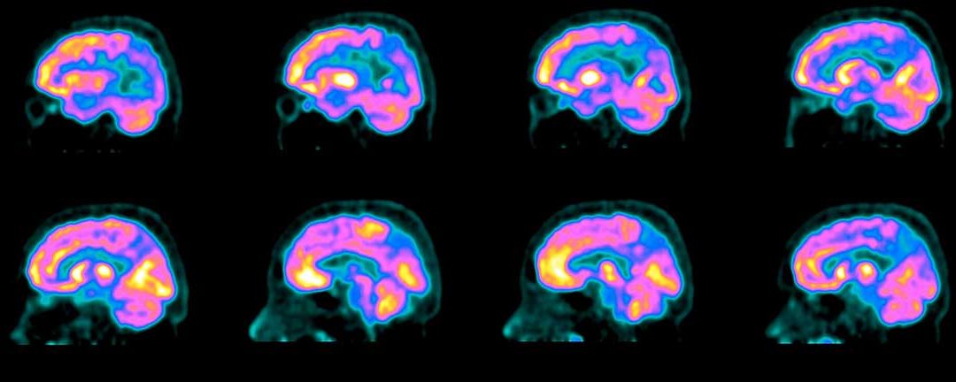 A Long-Sought Blood Test for Alzheimer’s is in Reach